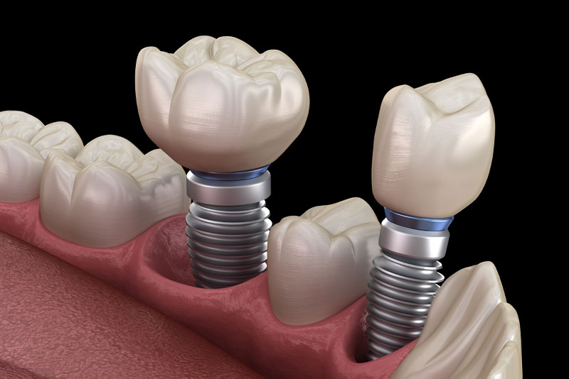 dental implants