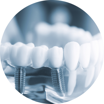 Round image single tooth dental implants image