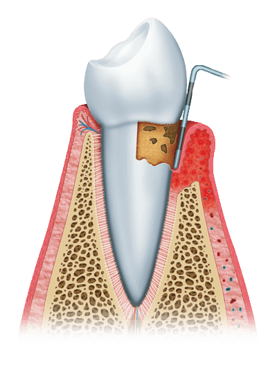 gum disease graphic stage2