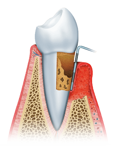 gum disease graphic stage3