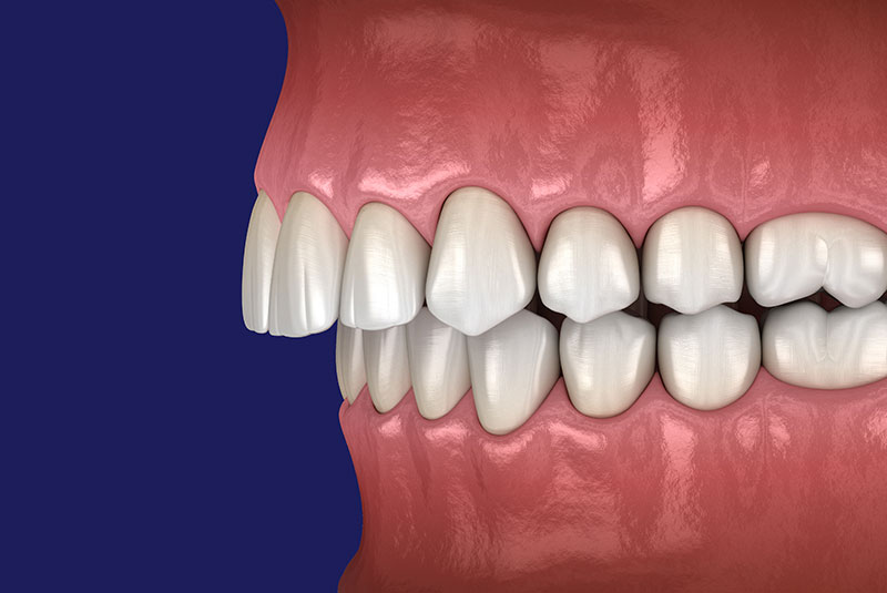 teeth alignment